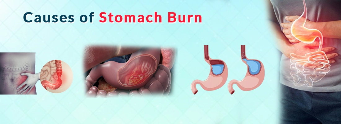 Causes of Stomach Burn